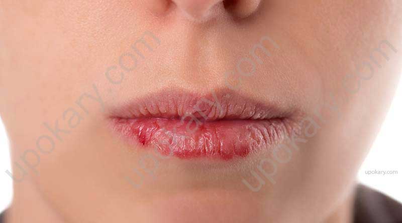 Chapped lips