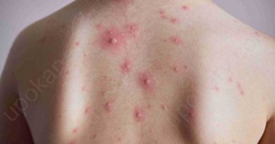 chicken pox