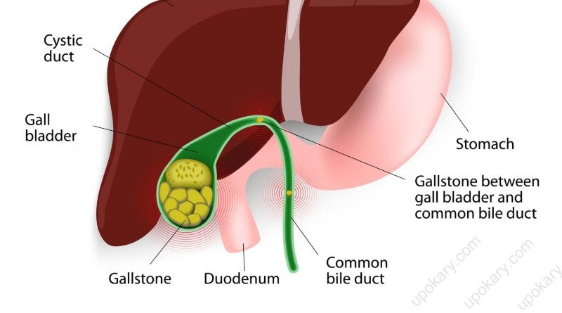 gallstone