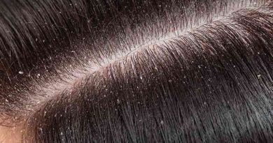 hair dandruff