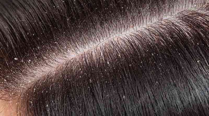 hair dandruff
