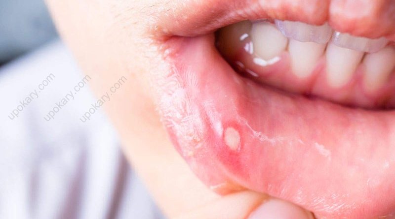 mouth sore