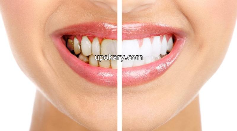 black spots on teeth