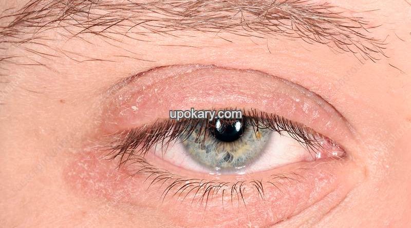 Rash or tingling in the eyelids