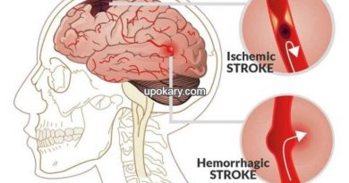 Causes of stroke