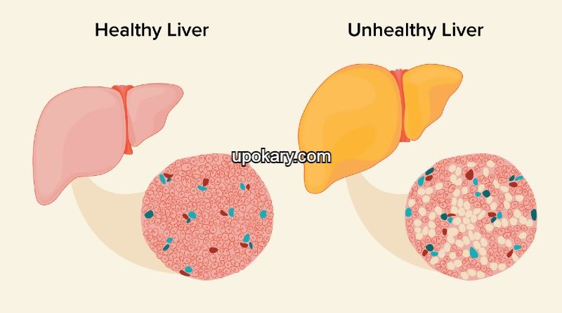 Fatty Liver