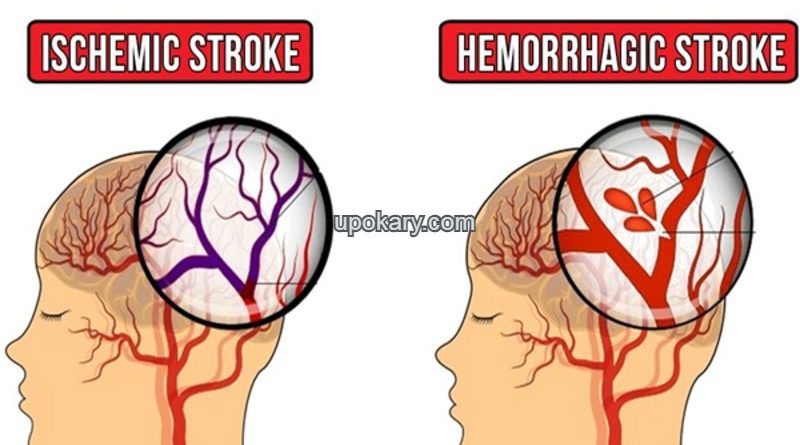 causes of stroke