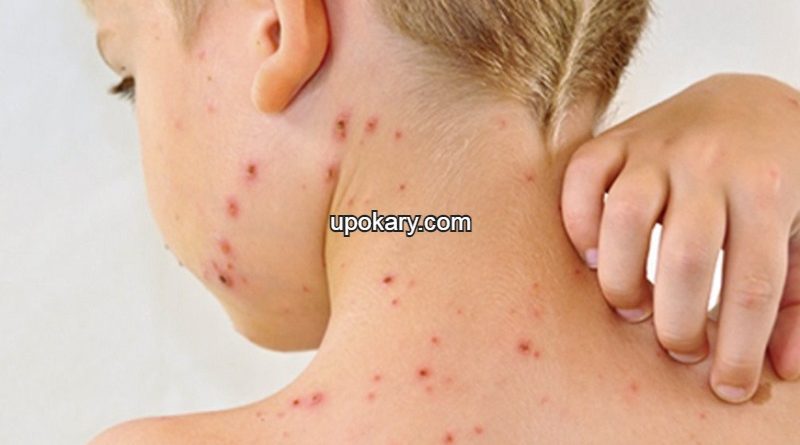 Chicken pox