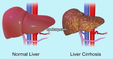 Liver Cirrhosis