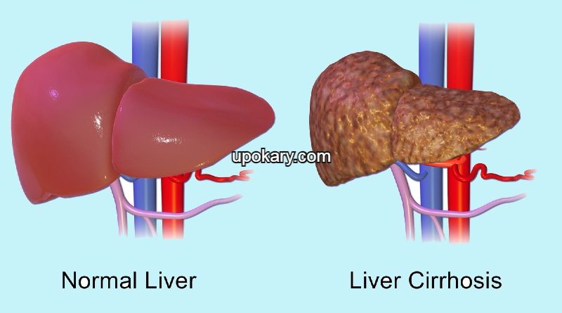 Liver Cirrhosis
