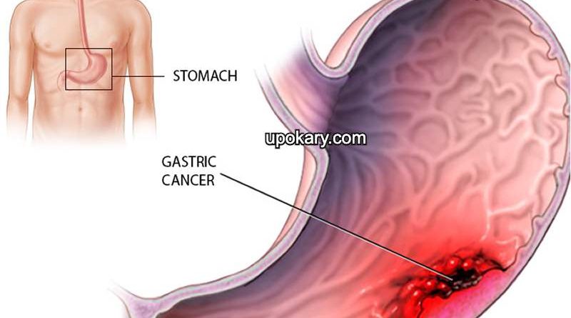 stomach cancer
