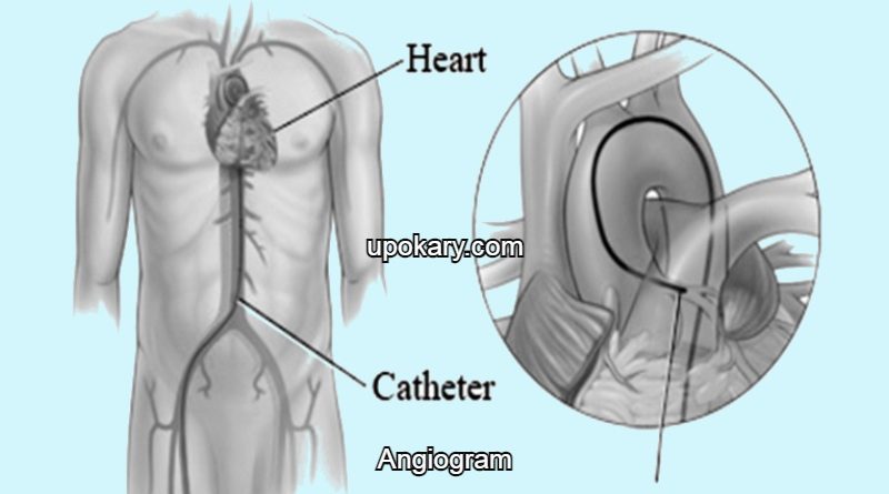 Angiogram