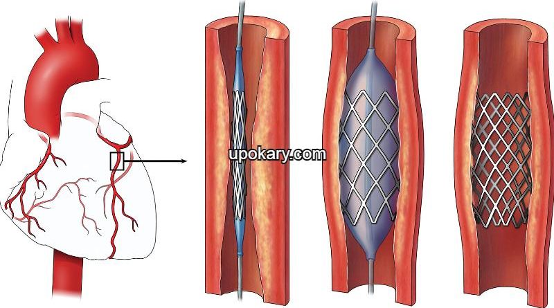 Angioplasty or Stent
