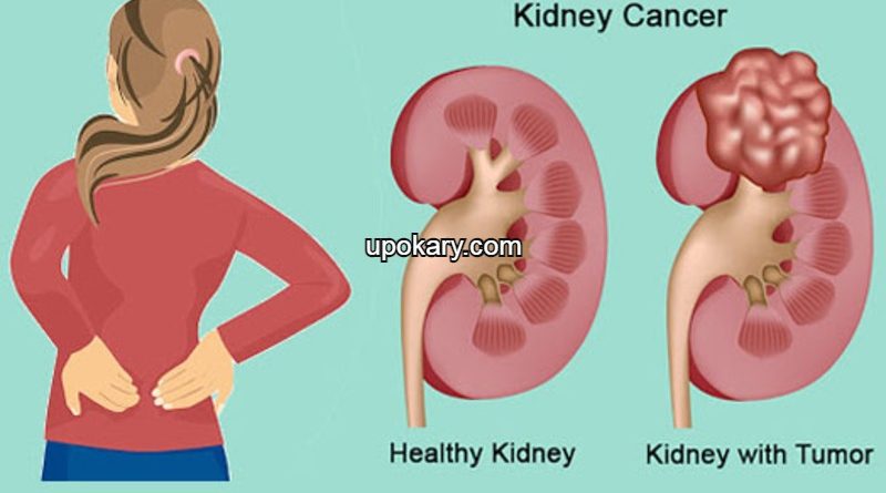 KidneyCancer