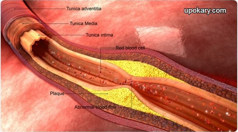 LDL cholesterol