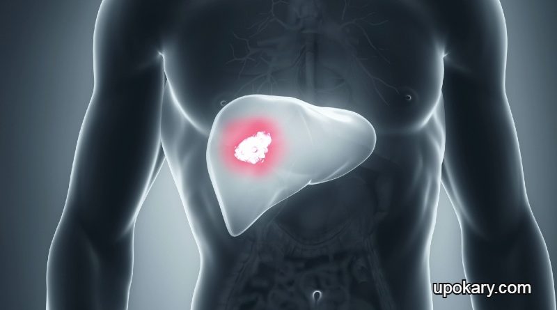 Liver cancer