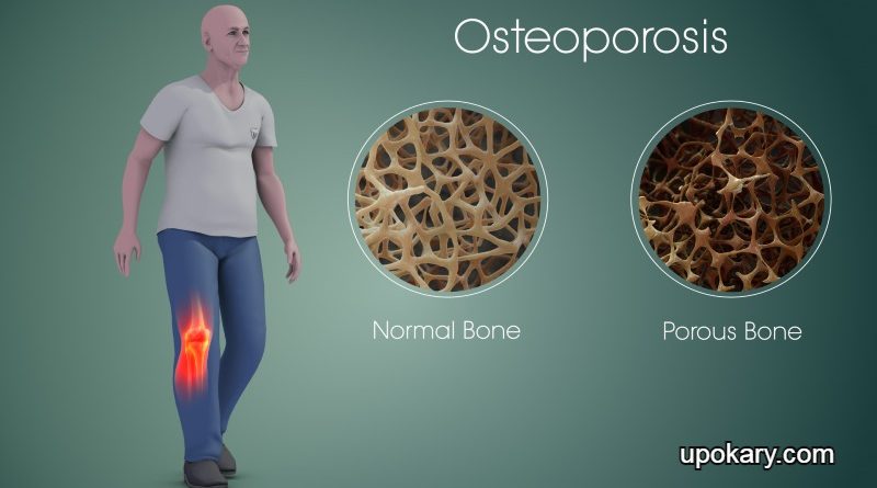 Osteoporosis