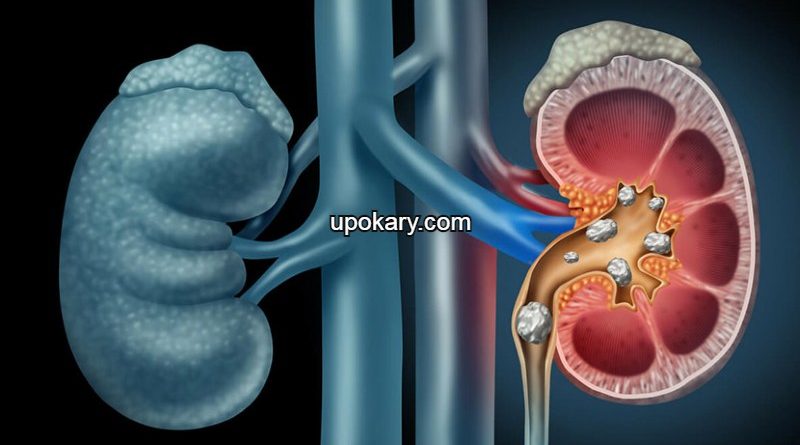 kidney stone