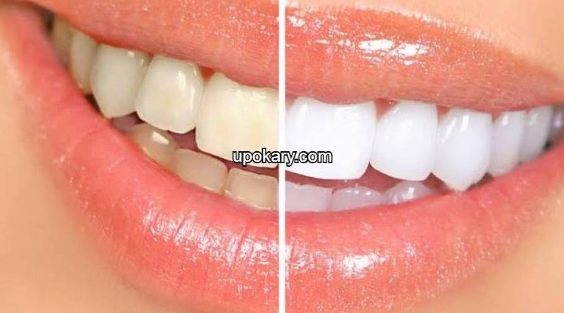 What is dental scaling