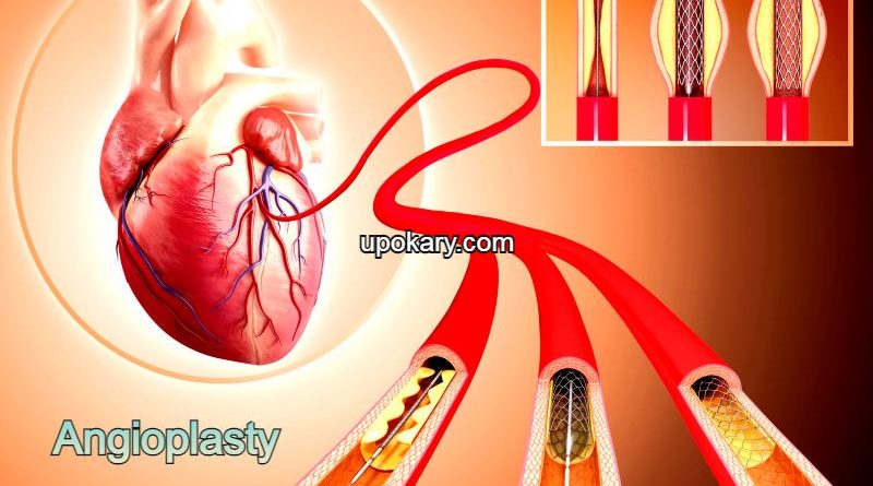 Angioplasty