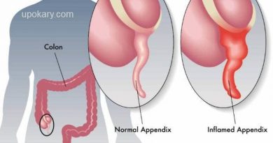 অ্যাপেনডিসাইটিস