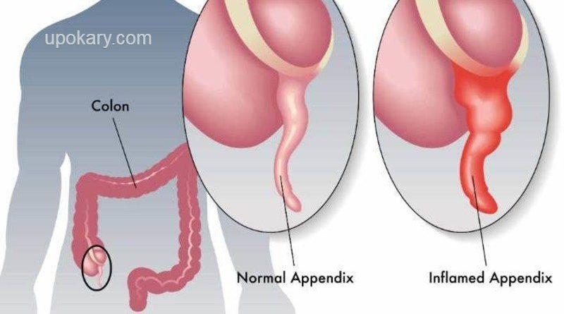 অ্যাপেনডিসাইটিস