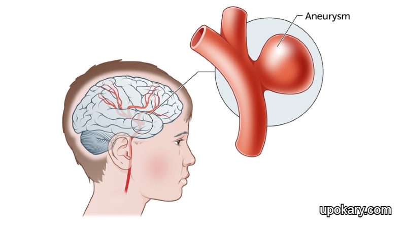 Brain_aneurysm