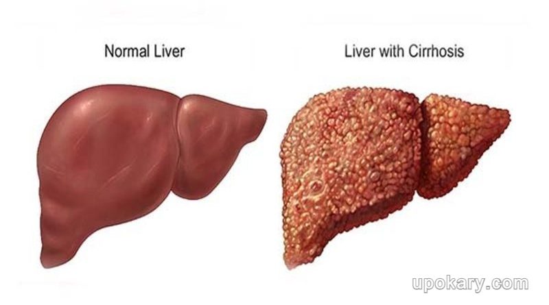 অ্যালকোহল সম্পর্কিত লিভারের রোগ