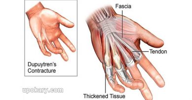 ডুপুইট্রেন সংকোচন