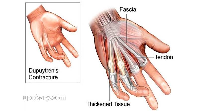 ডুপুইট্রেন সংকোচন