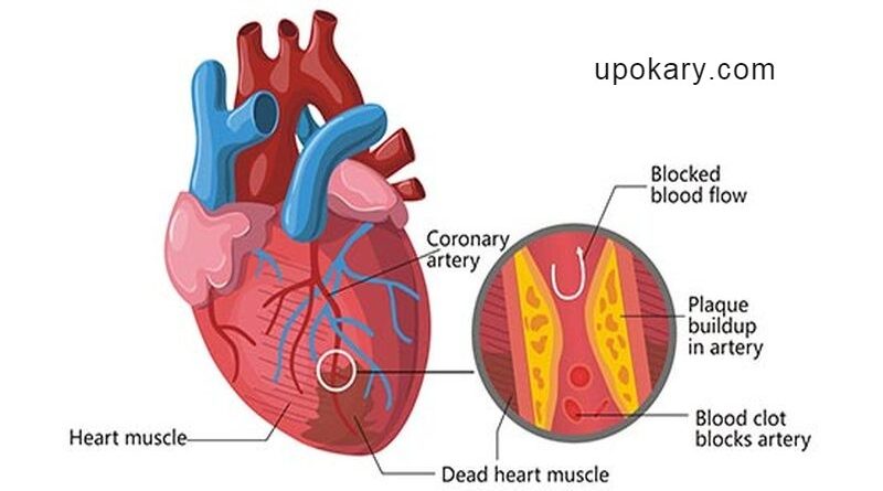 হার্ট অ্যাটাক