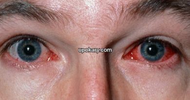 Conjunctivitis