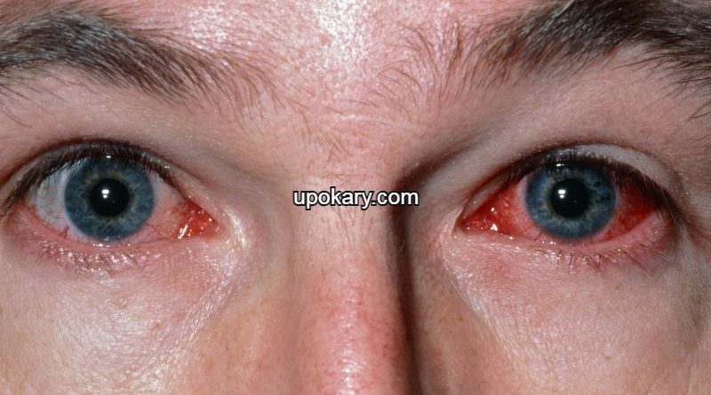 Conjunctivitis