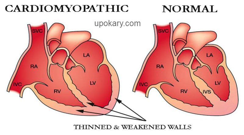কার্ডিওমায়োপ্যাথি